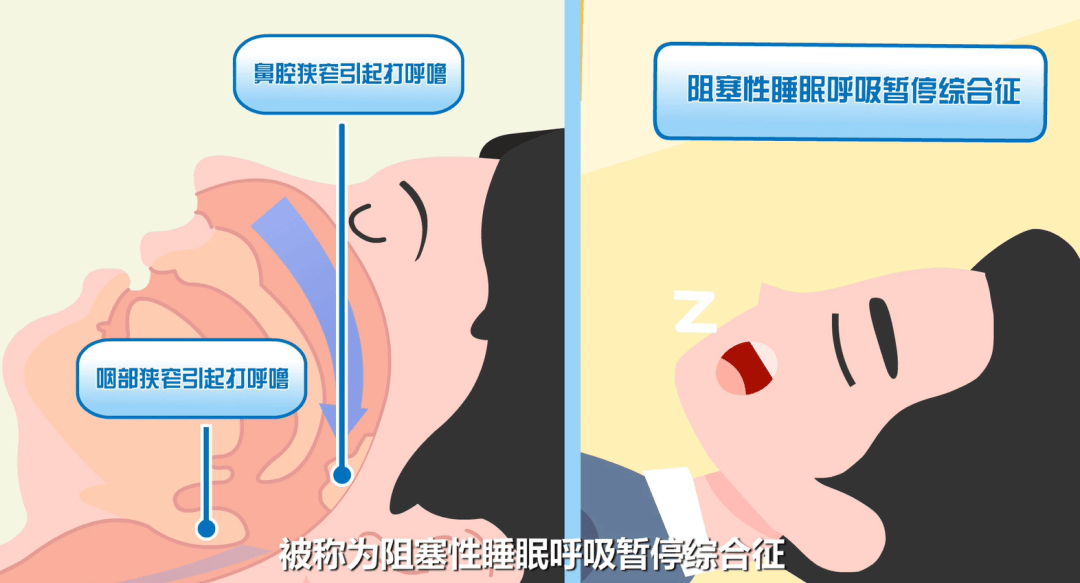 “打鼾人”的睡眠并不健康，你知道吗