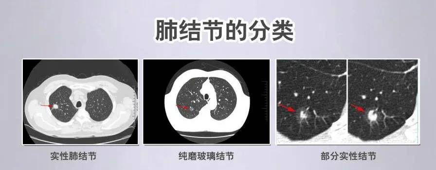 肺结节判断性质可分为实性结节、部分实性结节和纯磨玻璃密度结节三种。结合结节大小不一，相对恶性风险：部