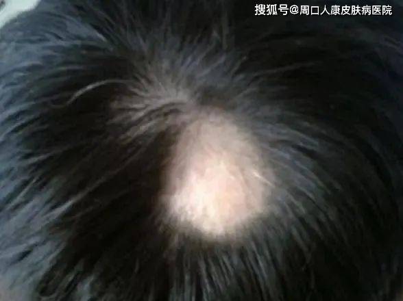 【周口人康皮肤病医院】斑秃的病因，6大原因导致斑秃