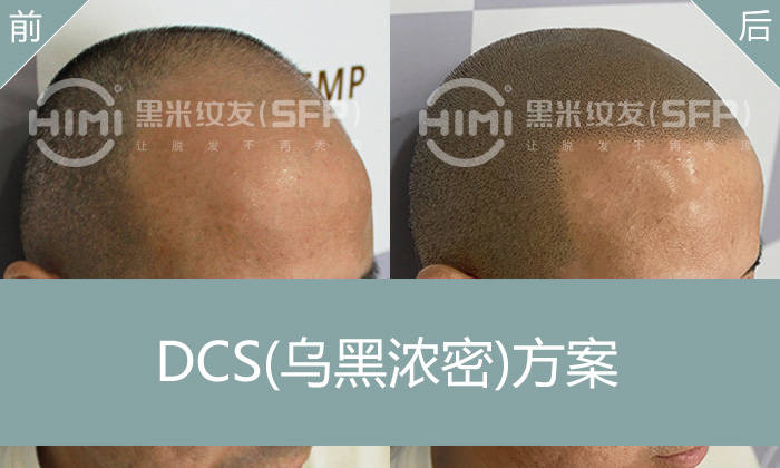 发际线太高可以纹发，解决发际线太高难题
