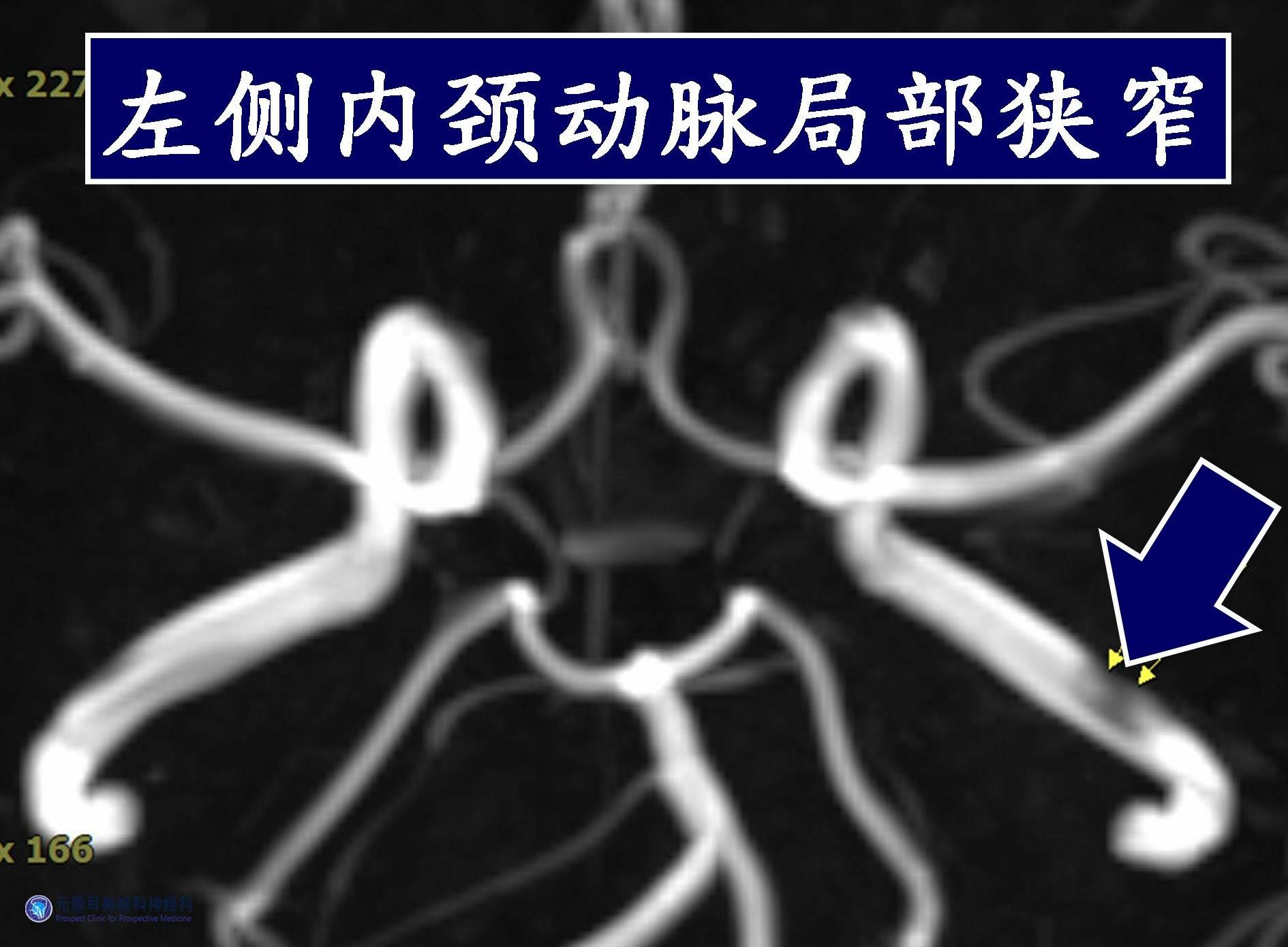 台湾眩晕权威警示：慢性头痛或为内颈动脉狭窄信号(图2)