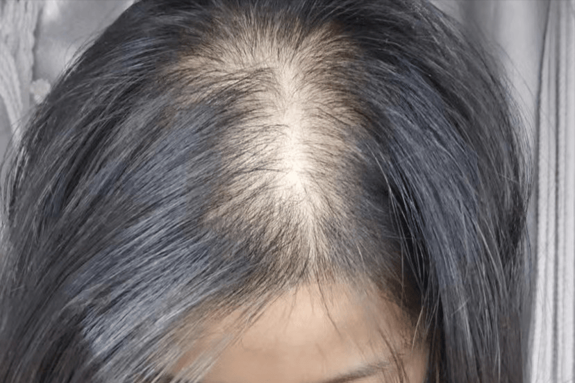 头发少、发际线后移？做到这几点，小碎发蹭蹭长！