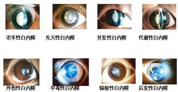 白内障的这些典型症状，你知道几个？