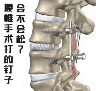 腰椎间盘突出症：何时该手术？何时能保守？