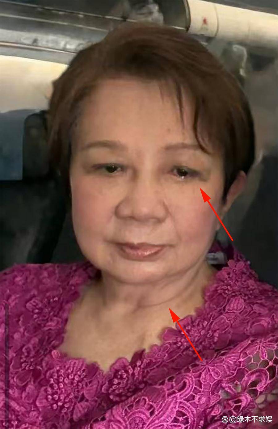 小S婆婆澳门旅游，眼含泪光心情悲痛，眼角淤青疑似受伤！