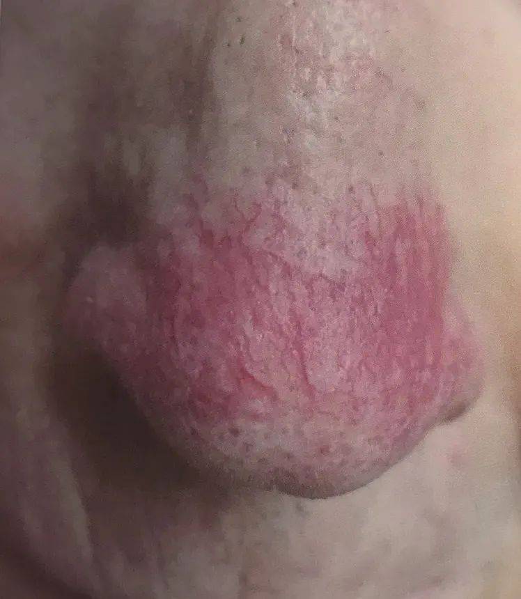 长沙权威皮肤病医院丨玫瑰痤疮能治好吗？该怎么治？