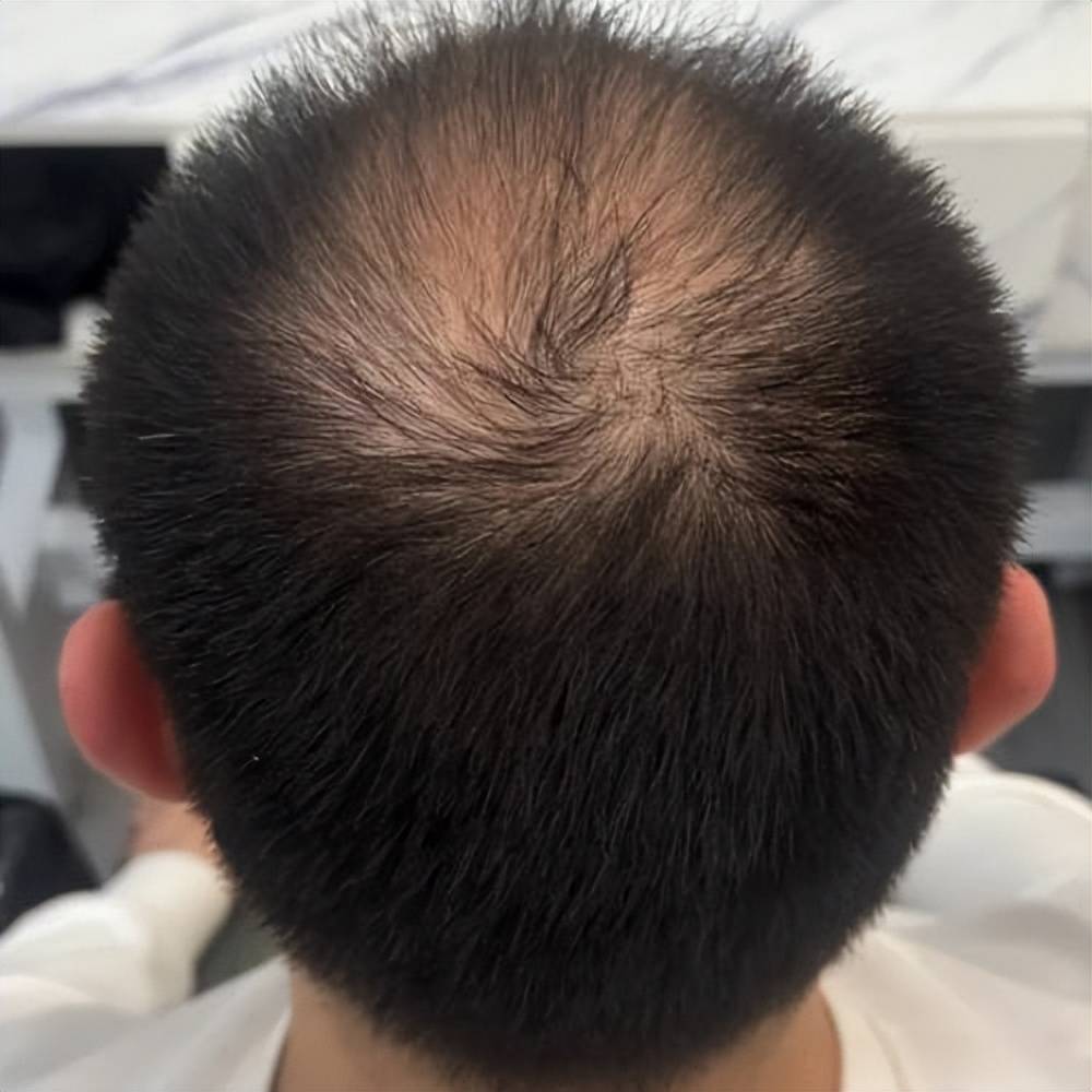 怎样治脱发效果比较好?快速生发最好的方法!