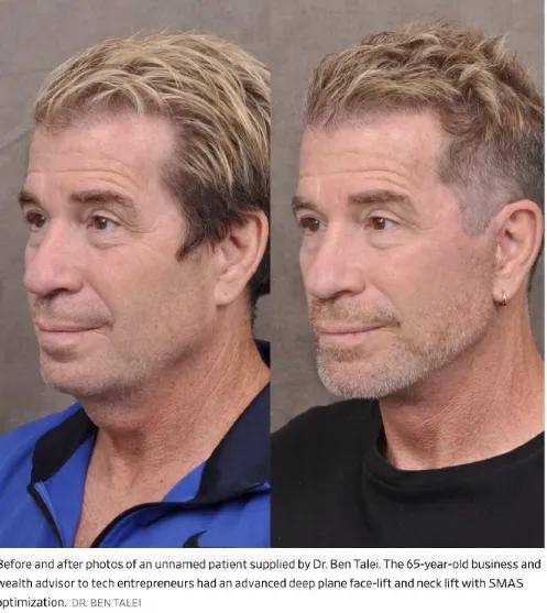 原创             996卷成002后,硅谷科技男为不被裁员扎堆做医美……