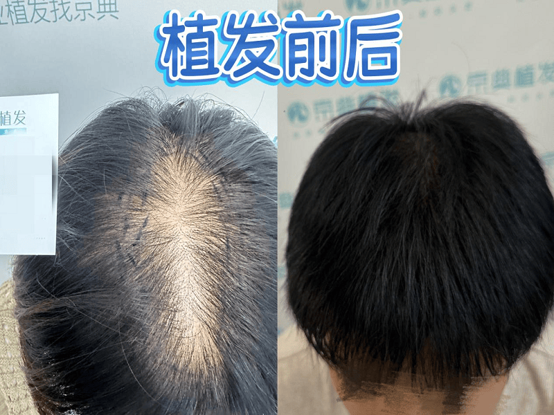 雄激素脱发诊疗相关常识科普