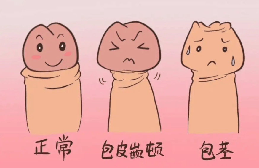 这四种情况需要做包皮手术，请对号入座_龟头_丁丁_建议