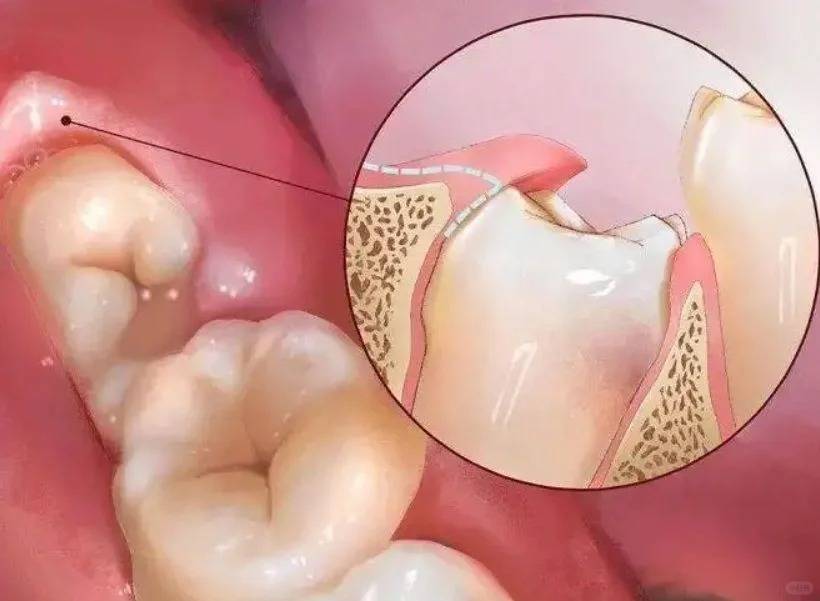 邢台口腔颌面外科专家蔡现良：智齿冠周炎都有哪些临床表现？(图3)