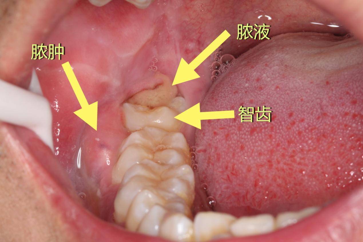 邢台口腔颌面外科专家蔡现良：智齿冠周炎都有哪些临床表现？(图2)