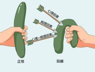 中年男人易阳痿？主要是这4个原因在作怪！