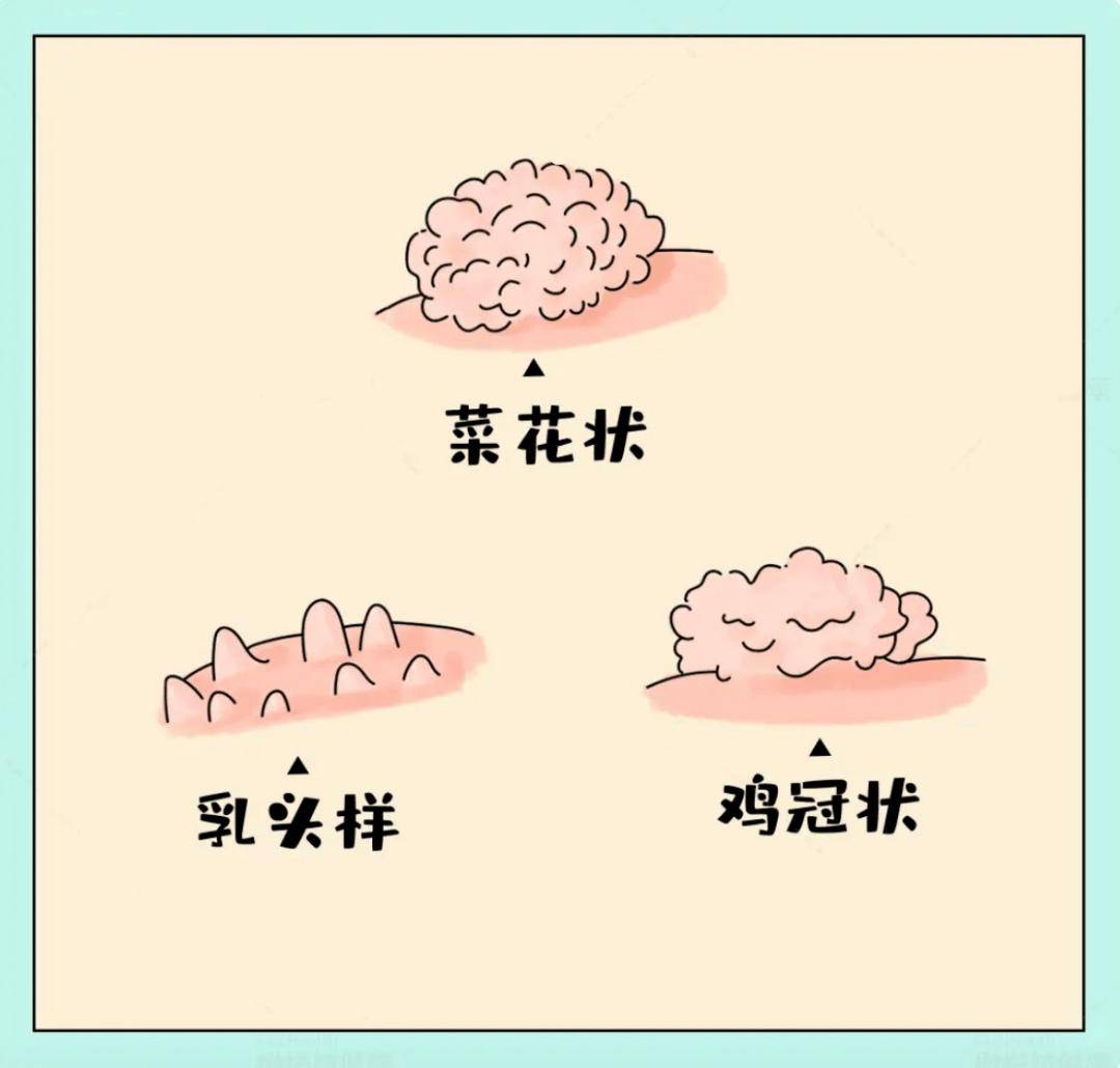 关于尖锐湿疣，您需要知道这些！