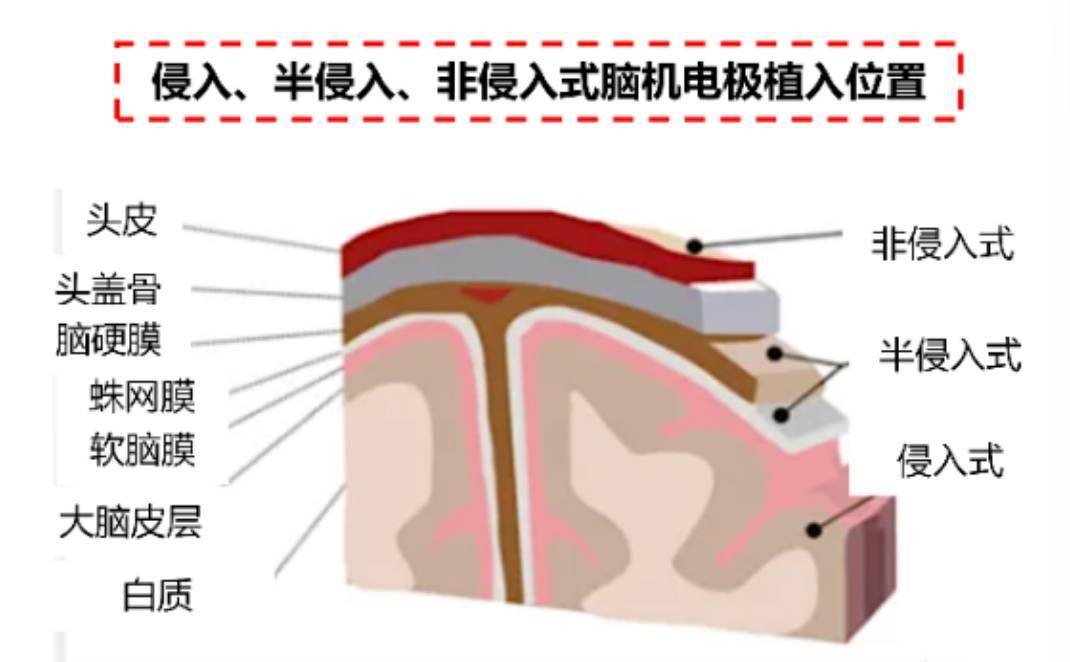 脑机接口虚火？但再不下手就晚了