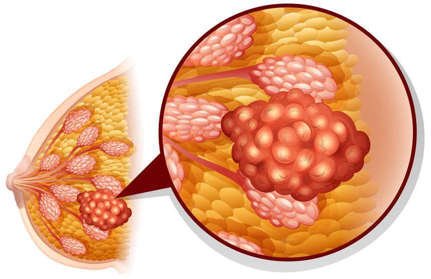 乳腺增生与乳腺癌究竟有何区别?可从这2方面分析