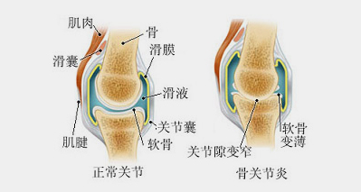 湘鄉賀競之疼痛科:骨關節炎,潛在的