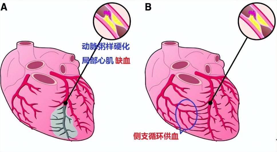 什么因素能导致心梗发作(影响心音本身产生强度的因素有哪些)