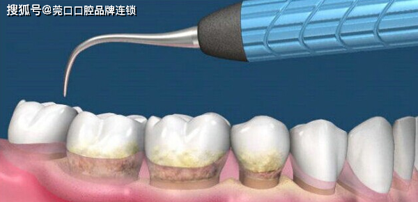 3,改善疾病:洗牙可能改善口腔黏膜病,甚至改善口腔癌症.