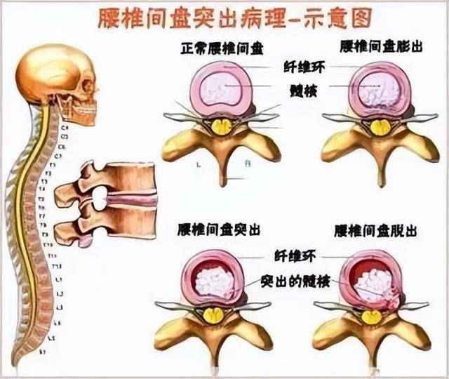 1个小孔就能治疗腰椎间盘突出症