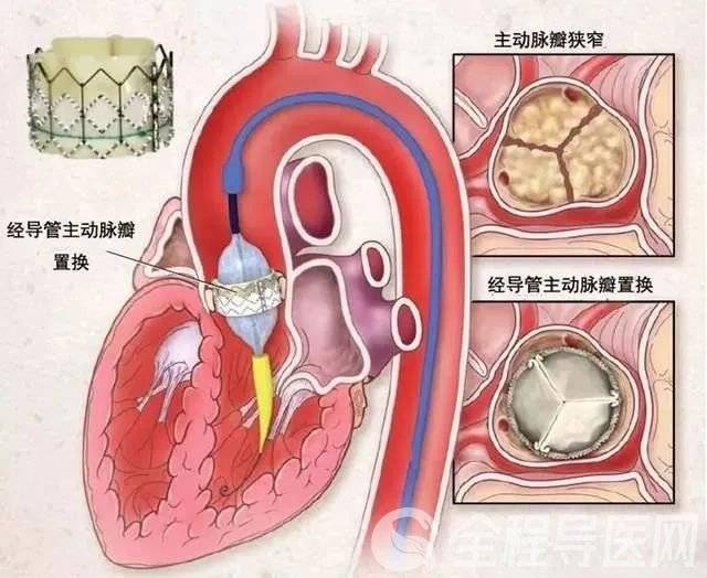 徐礦總醫院:不用開刀的心臟微創手術 主動脈瓣膜置換術_奶奶_患者