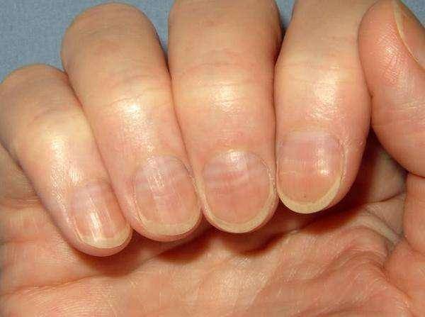 手指甲长不起来的原因为什么在线 手指甲长不起来的原因为什么在线