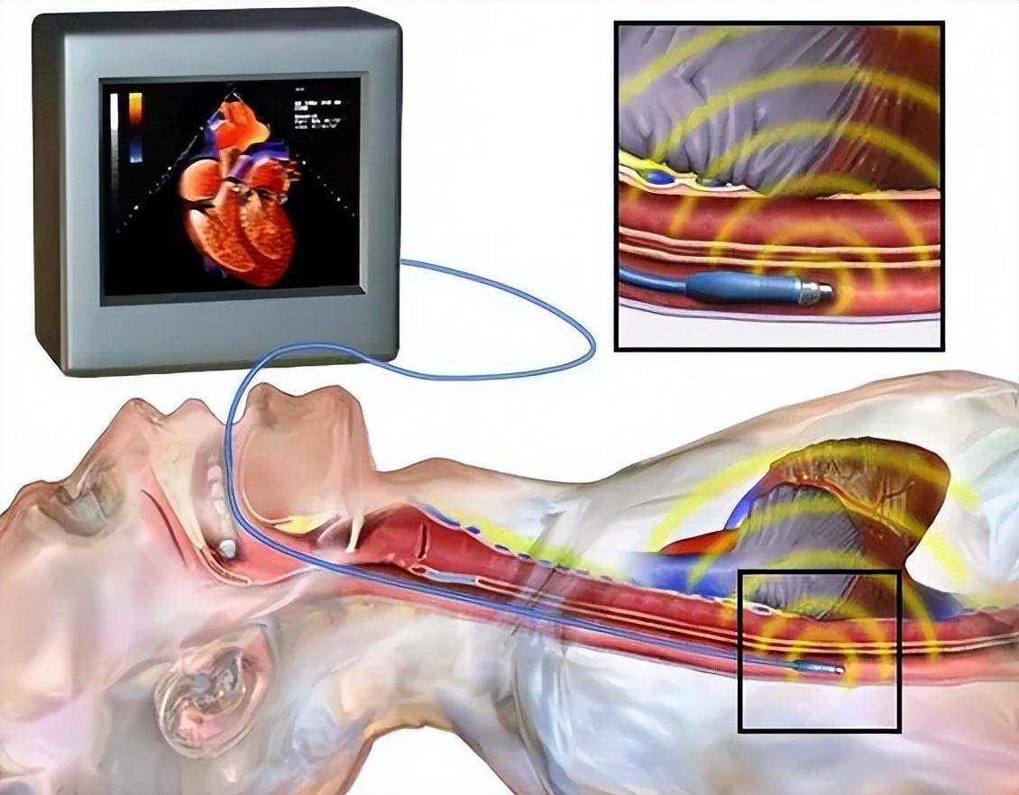 其中,经食道超声心动图结合右心声学造影及充分的激发试验是诊断卵园