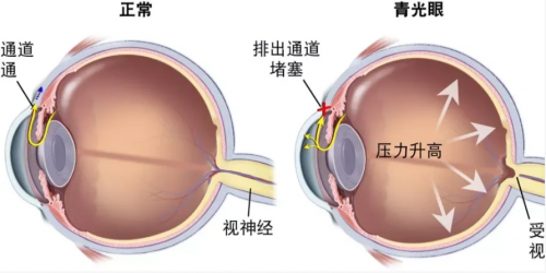 青光眼有什么症状?_发病_婴幼儿_眼压