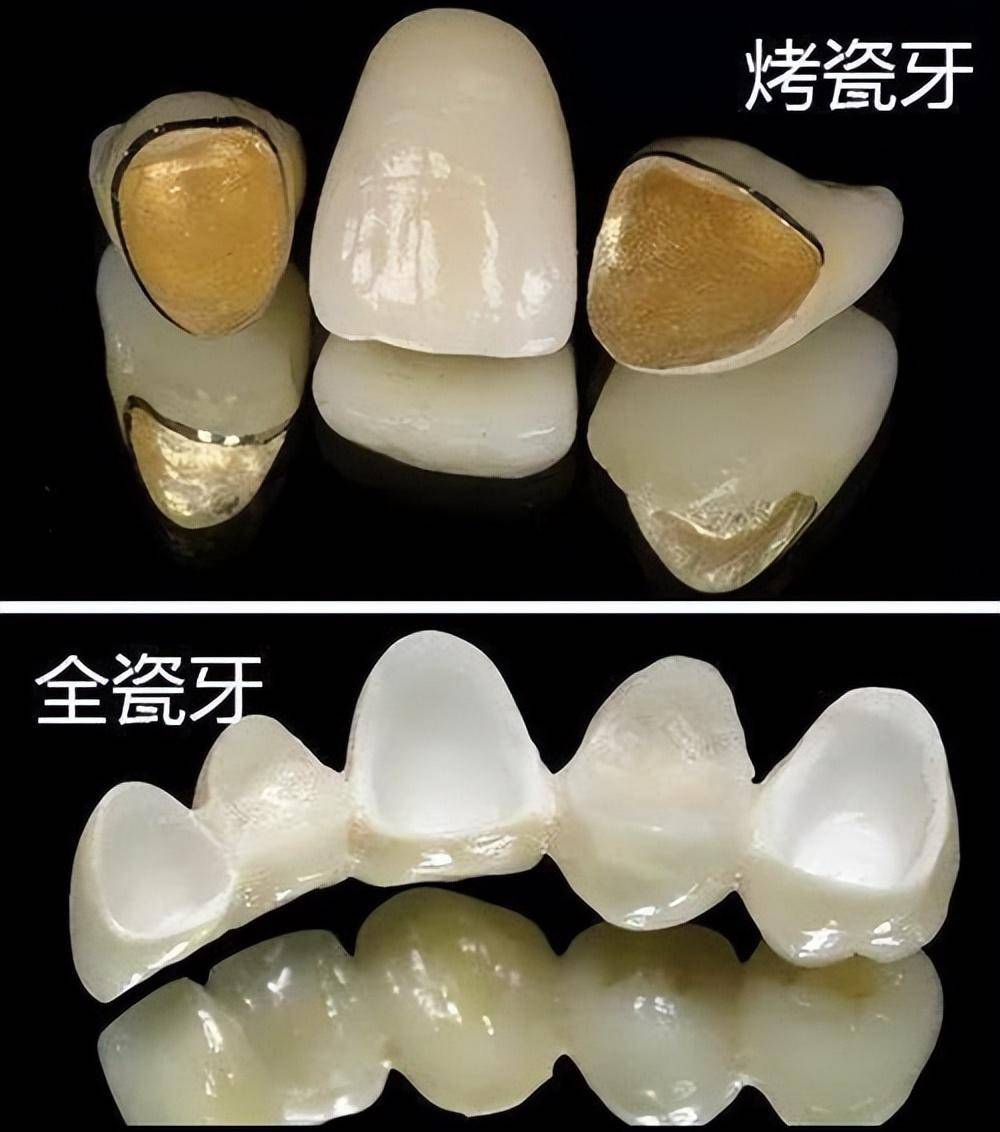 种植牙和烤瓷牙哪个好?一颗多少钱(附2024价格表)有什么弊端?