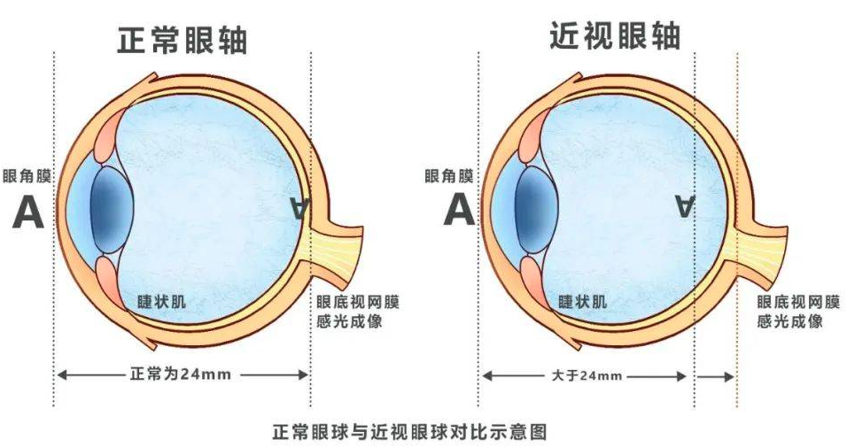 孩子视力检查为什么会测眼轴？湖北普瑞眼科医院专家告诉你