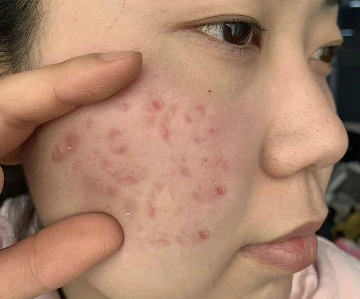 满脸红褐痘印怎么去除?分享3个好用国货,十年顽固痘印也能消!