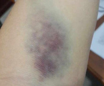 不稳定,击打轨迹漂移等问题,使用起来容易损伤皮肤和肌肉,出现淤青