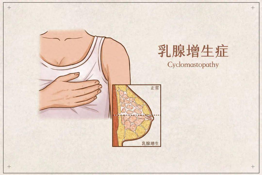 乳腺增生早期图片