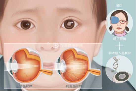 什麼樣的孩子會得先天性白內障?_眼睛_遺傳_晶狀體