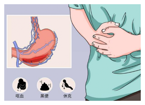 貴陽東大肛腸醫院:大便帶血,黑便,粘液膿血便?當心來!