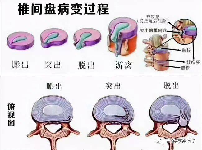 (5) 硬膜下型突出的髓核穿破硬膜進人硬膜下間隙,此種情況引起嚴重的