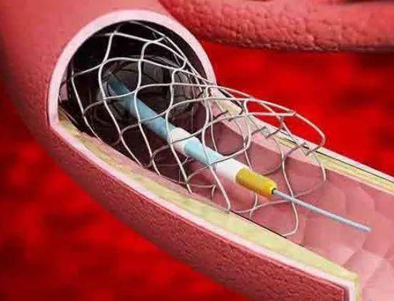钟南山院士放置心脏支架18年