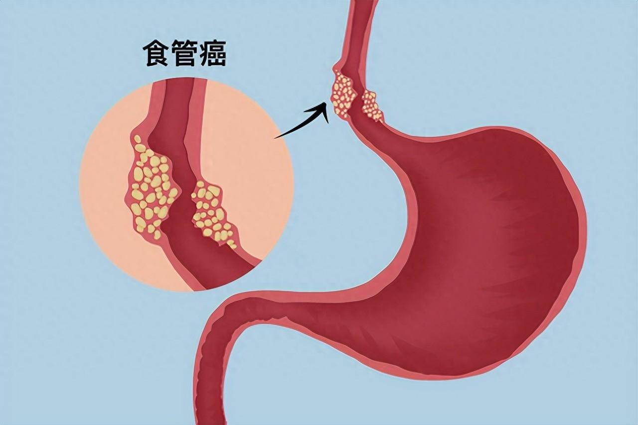 淋巴瘤饮食减肥吃主食吗(淋巴瘤饮食减肥吃主食吗会瘦吗)