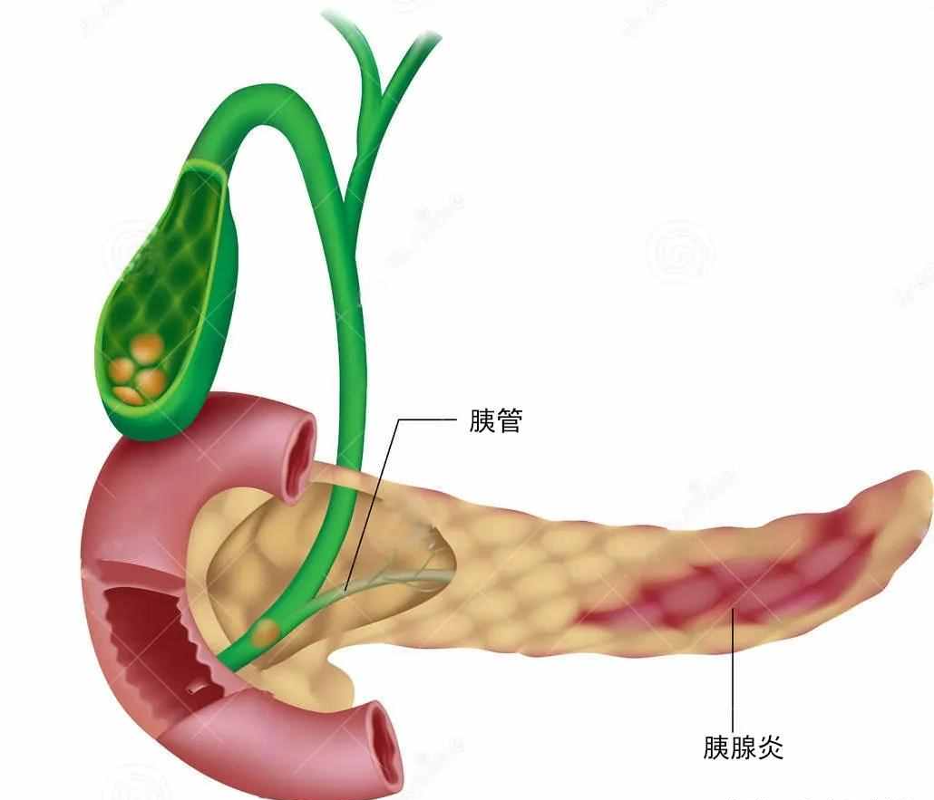 慢性胰腺炎会癌变吗?