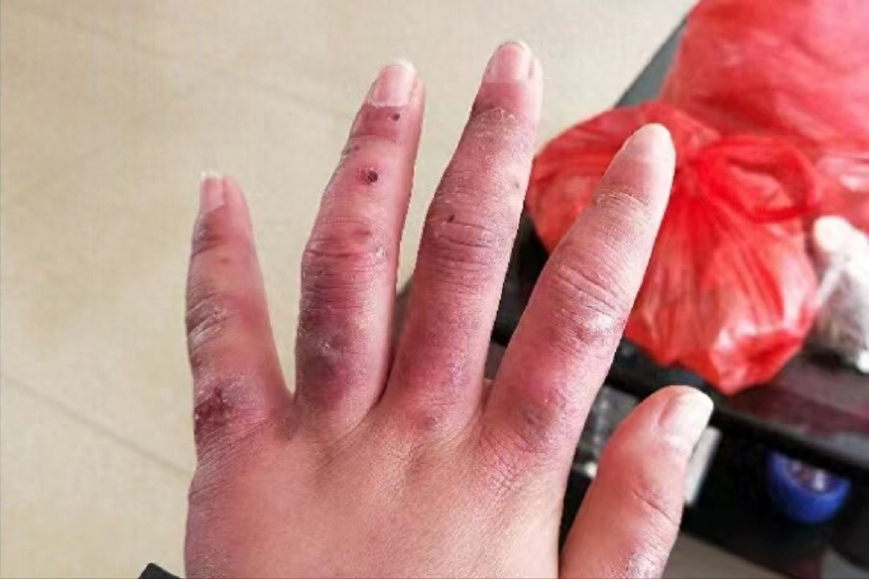 这3个方法对冻疮的杀伤力10000%!红肿,刺痒,疮口全都搞定!