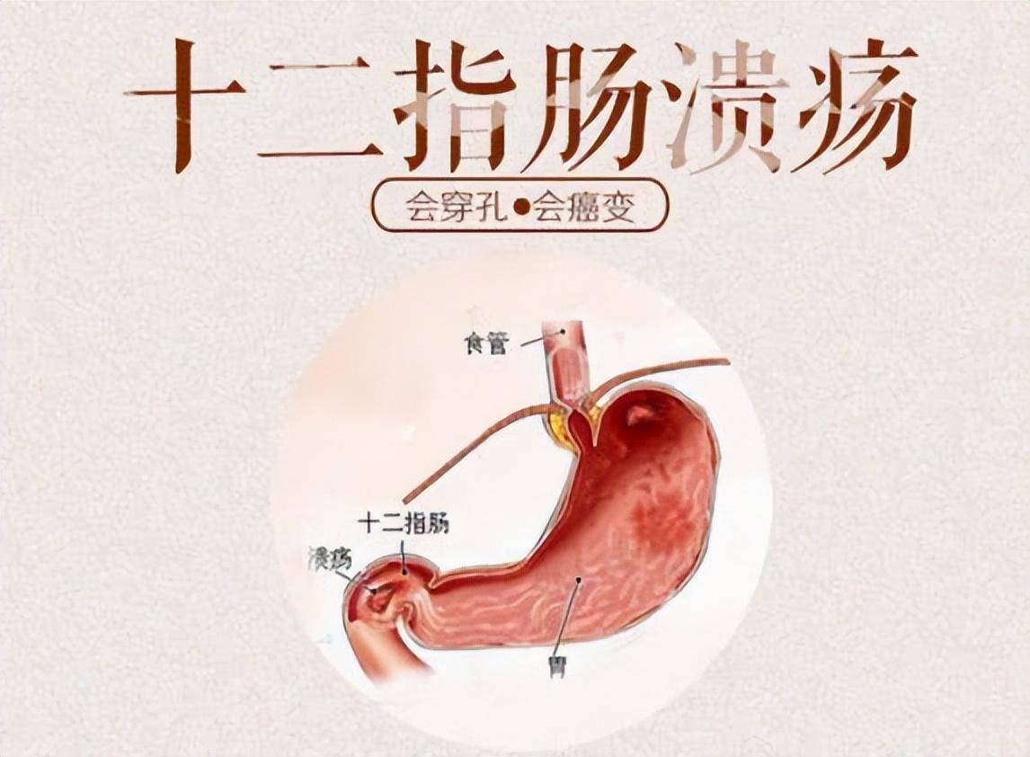 胃十二指肠溃疡症状图片