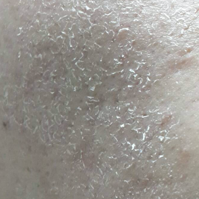 不长痘别用,关于水杨酸棉片使用必须知道的一些事