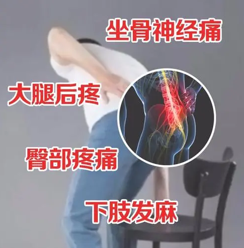 女性坐骨神经痛臀部疼图片