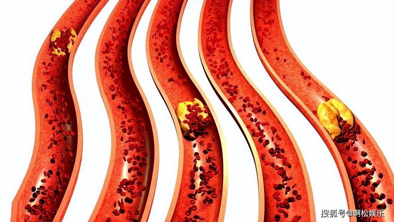 血脂高的人想要血管健康,早晨起床后,这4件事能不做则不做