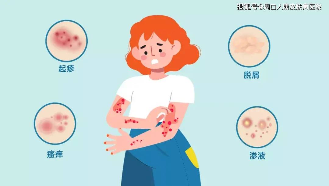 【周口人康皮肤病医院】皮炎会不会引起脱皮呢?_症状_细胞_现象