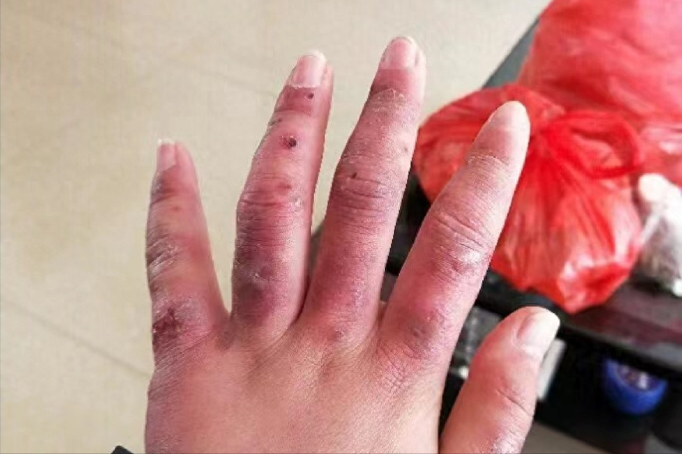 冻疮过来人血泪经验!红肿疙瘩千万不要拖!用这招轻松搞定!