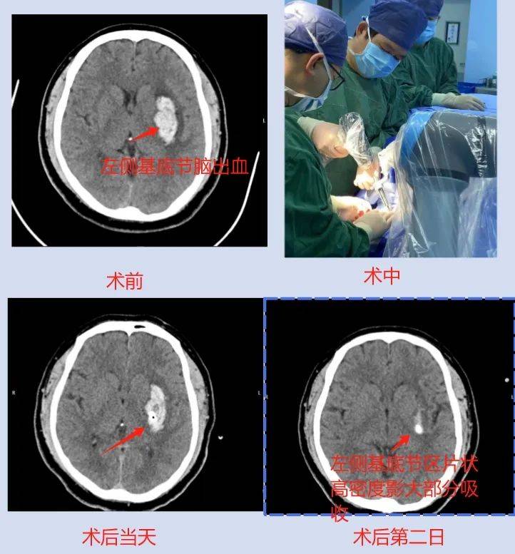 一例機器人輔助下左側顱內血腫穿刺置管引流術_患者