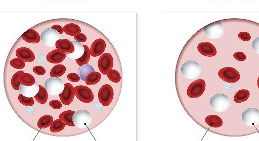 小儿贫血发病率高,占儿童四大疾病之首_红细胞_原因_缺铁性