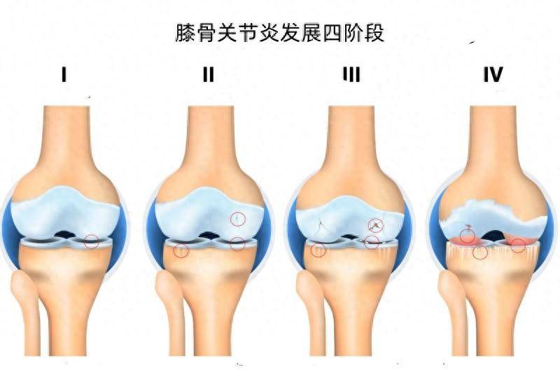 关节软骨的位置图片