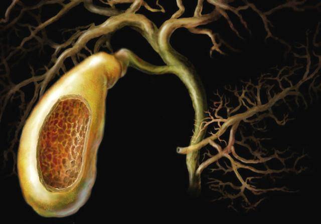 3种疾病或会找上门,能不切别切_治疗_症状_胆汁